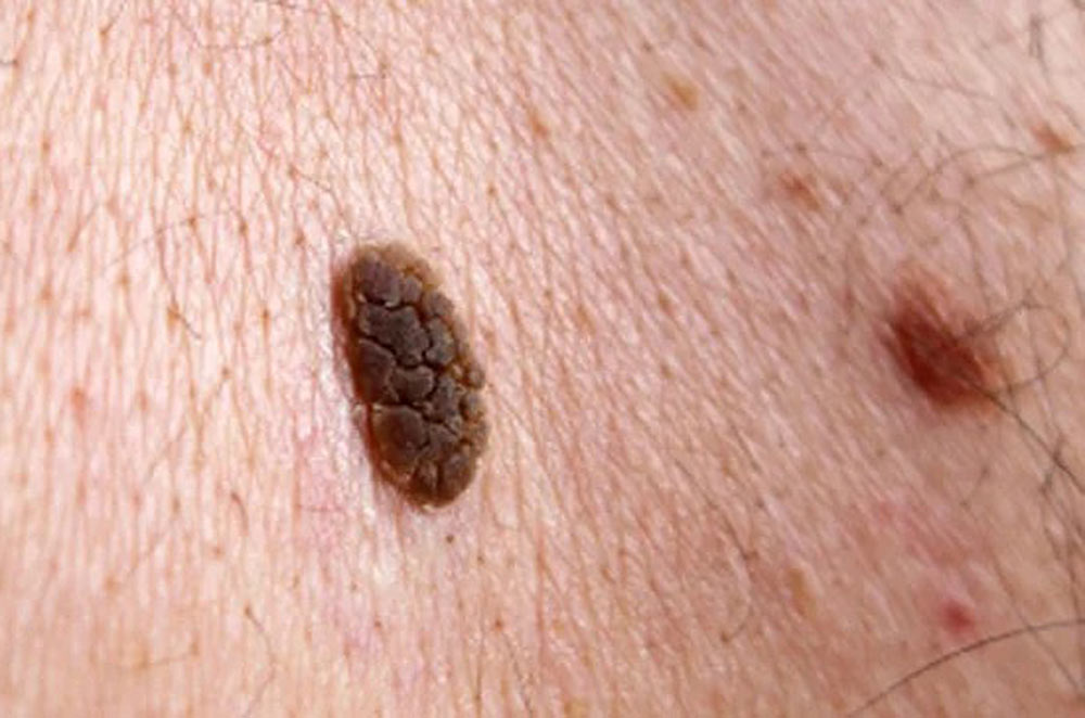 Seborrhoeic Keratoses