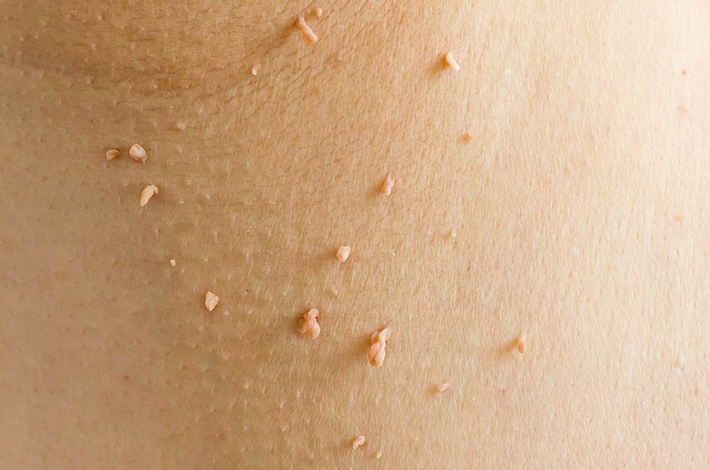 Skin tags